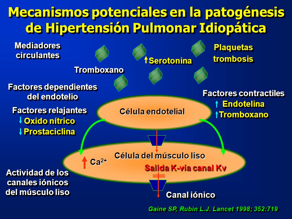 Actualización de hipertensión pulmonar idiopática en línea